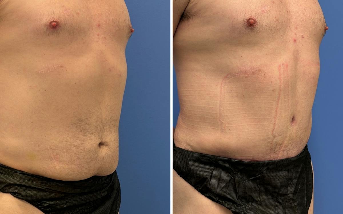 Abdominoplasty Before & After Gallery - Patient 159783 - Image 2