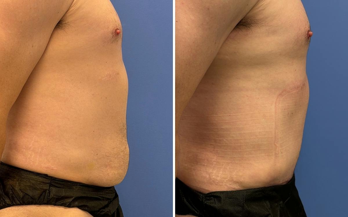 Abdominoplasty Before & After Gallery - Patient 159783 - Image 3