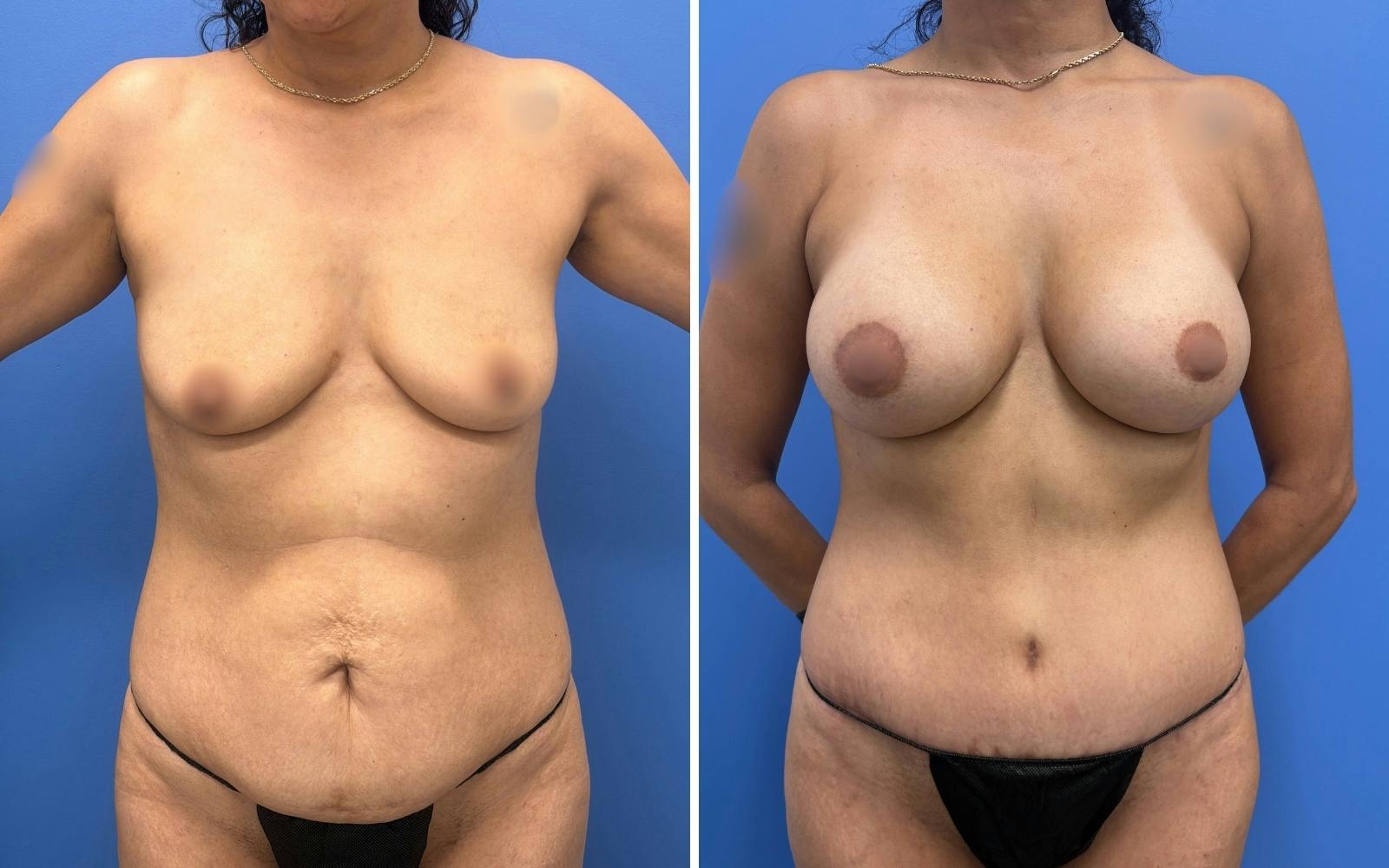 Abdominoplasty Before & After Gallery - Patient 408771 - Image 1