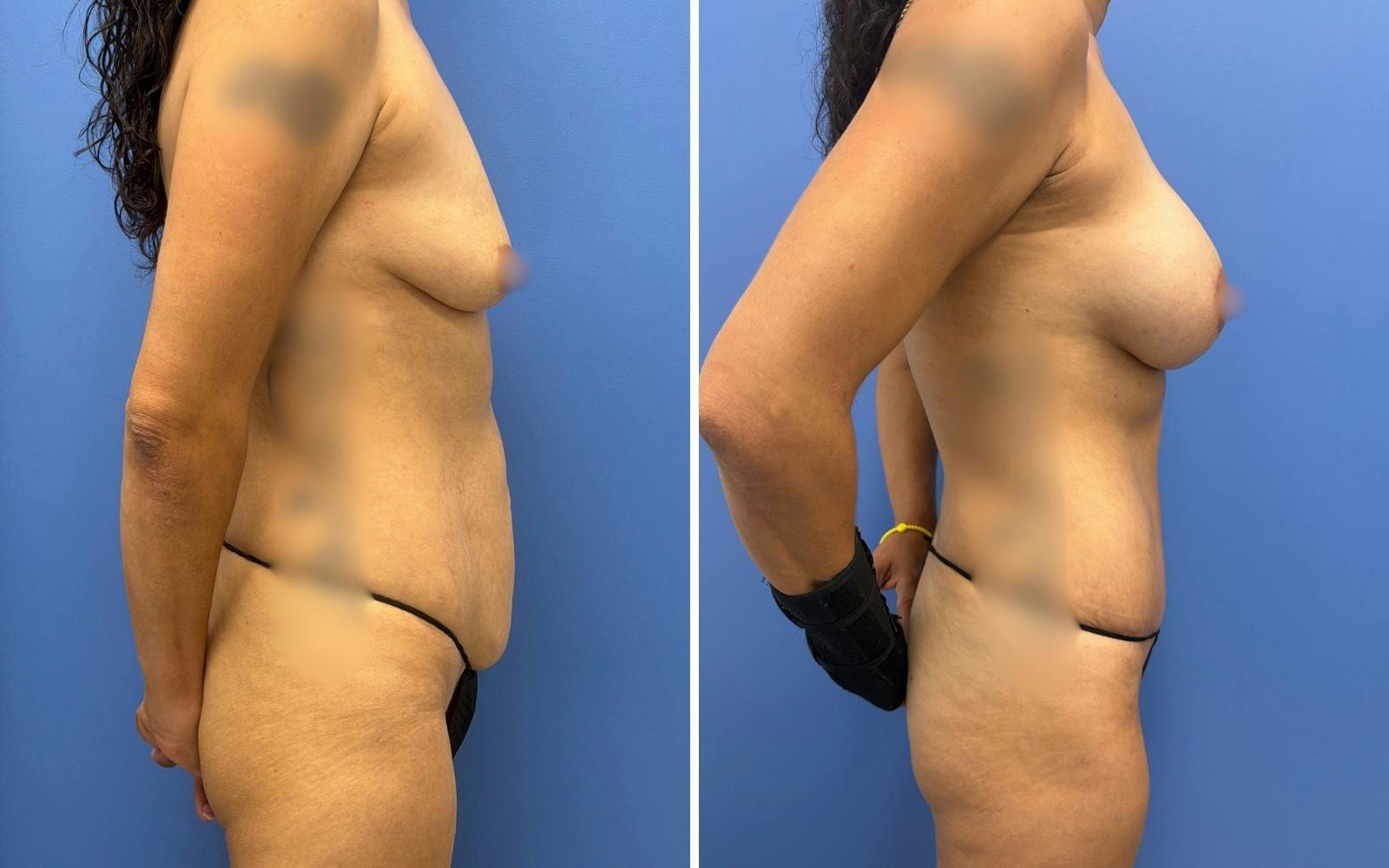 Abdominoplasty Before & After Gallery - Patient 408771 - Image 3