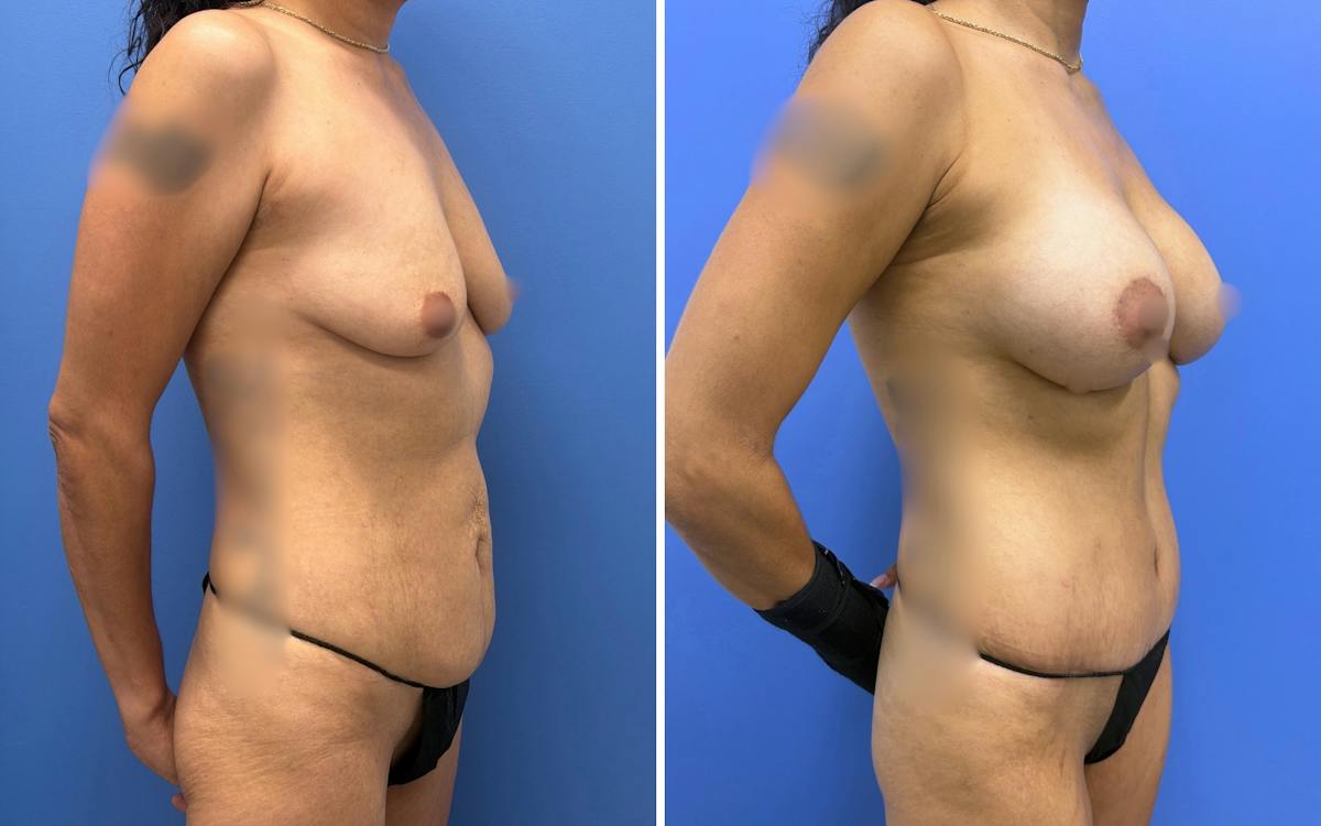 Abdominoplasty Before & After Gallery - Patient 408771 - Image 2