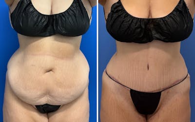 Abdominoplasty Before & After Gallery - Patient 421499 - Image 1