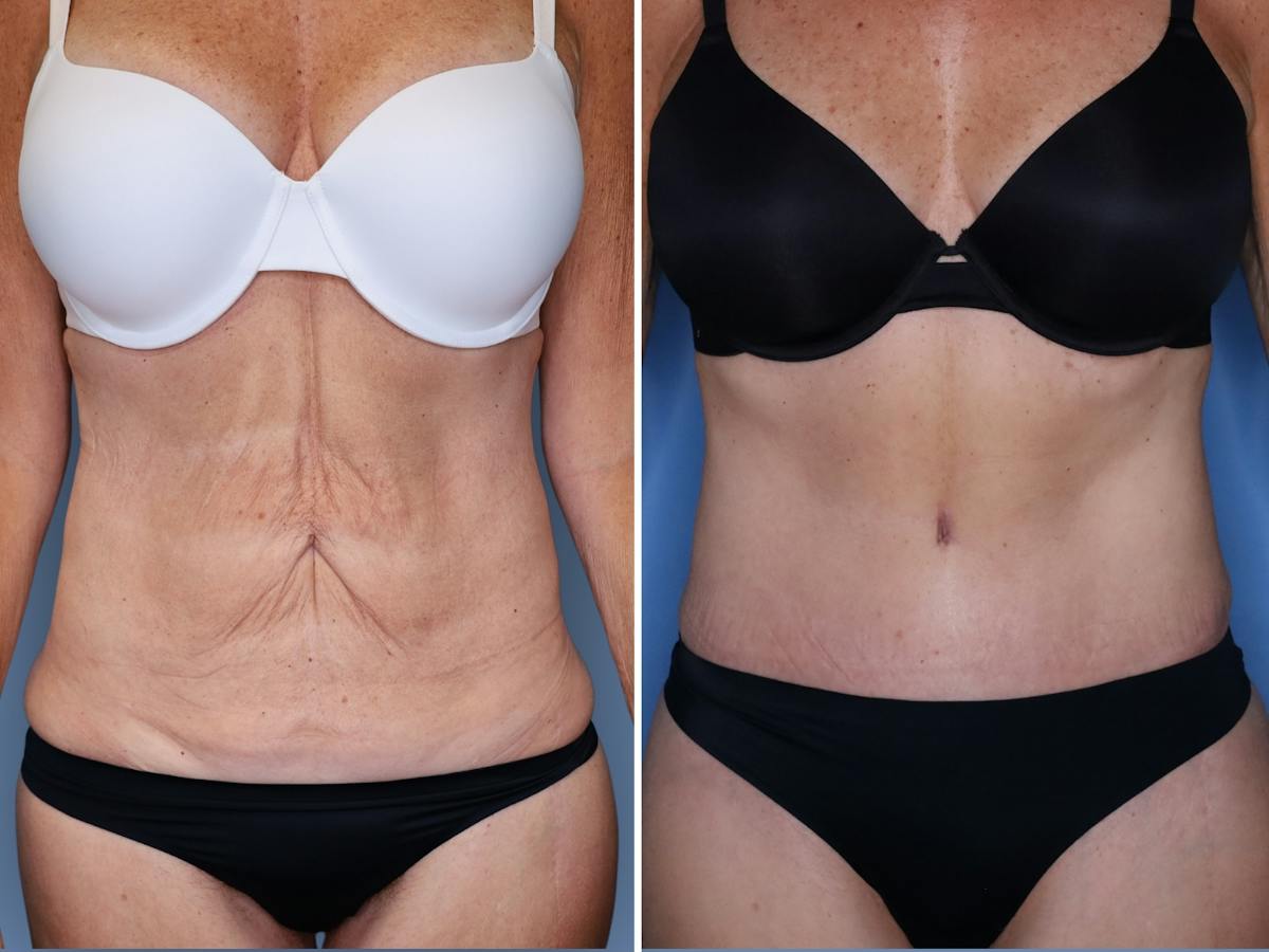 Abdominoplasty Before & After Gallery - Patient 285960 - Image 1