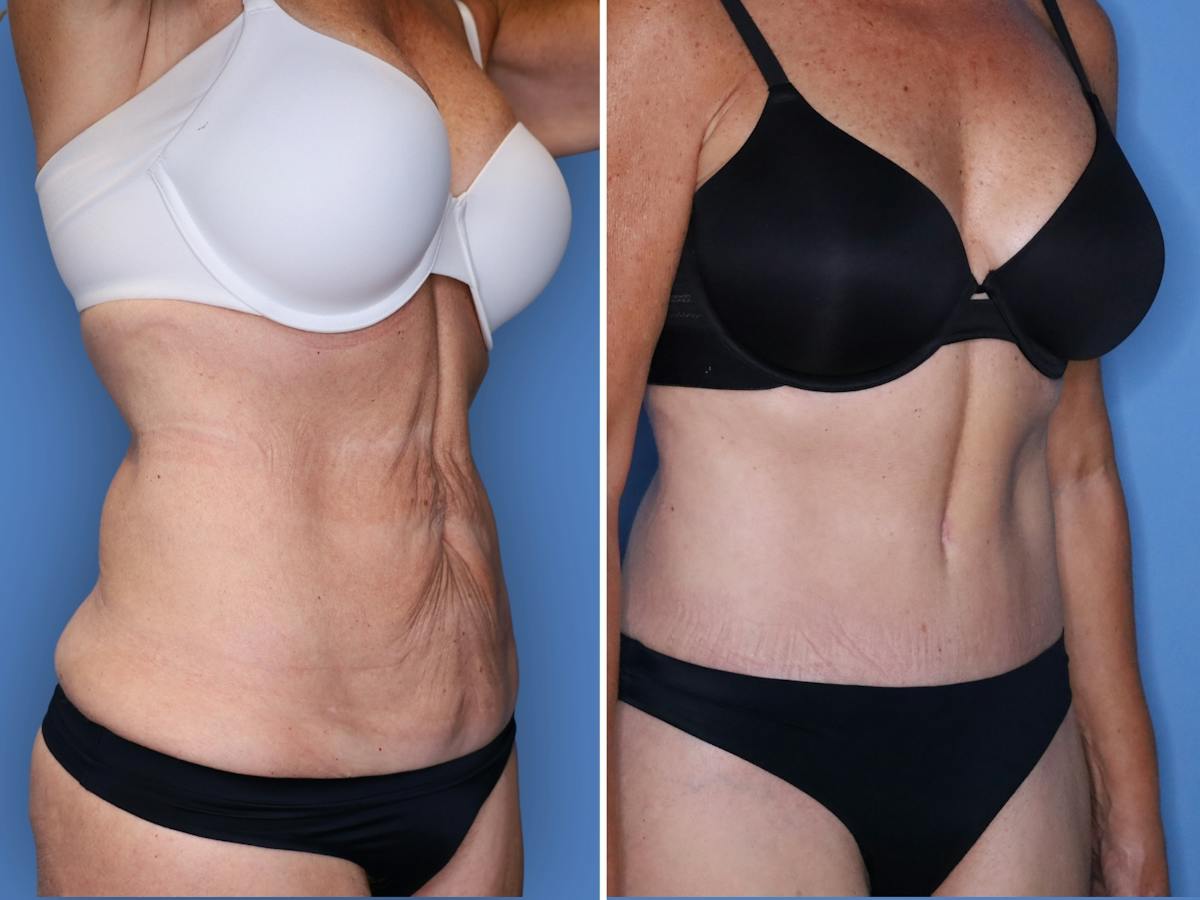 Abdominoplasty Before & After Gallery - Patient 285960 - Image 2
