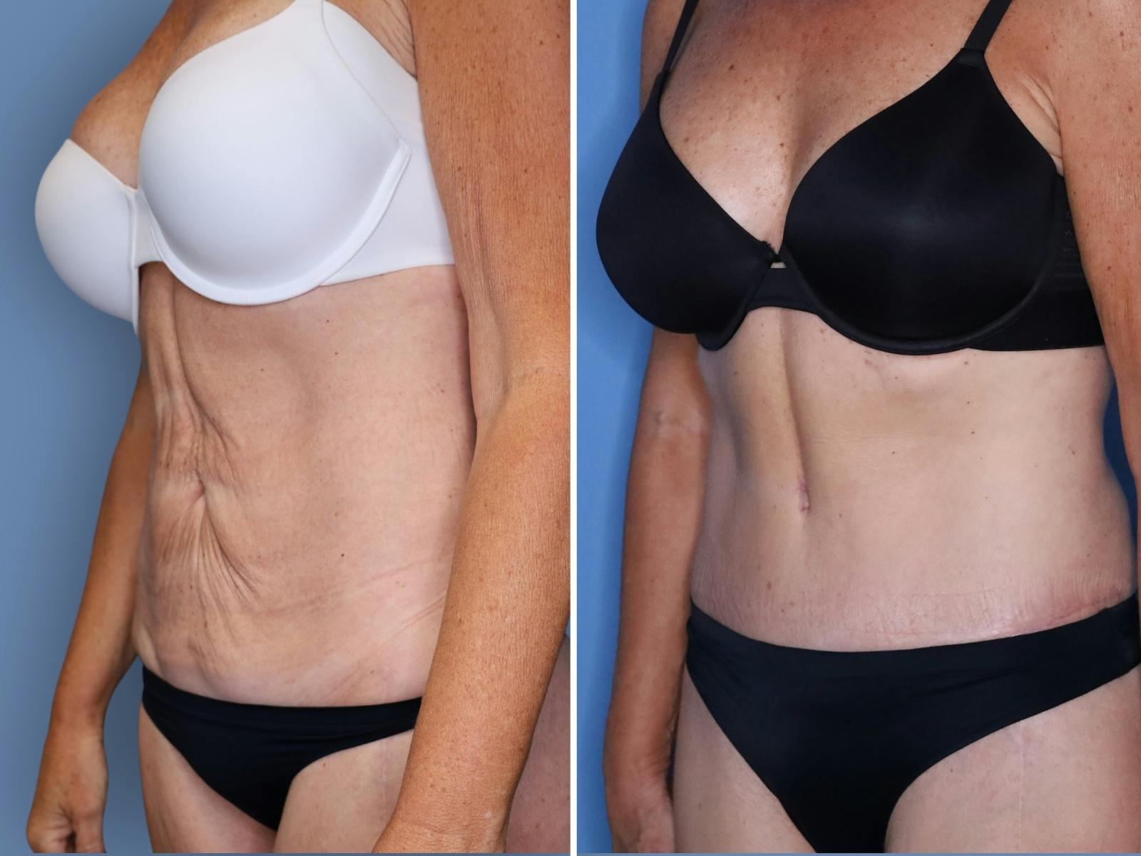 Abdominoplasty Before & After Gallery - Patient 285960 - Image 4