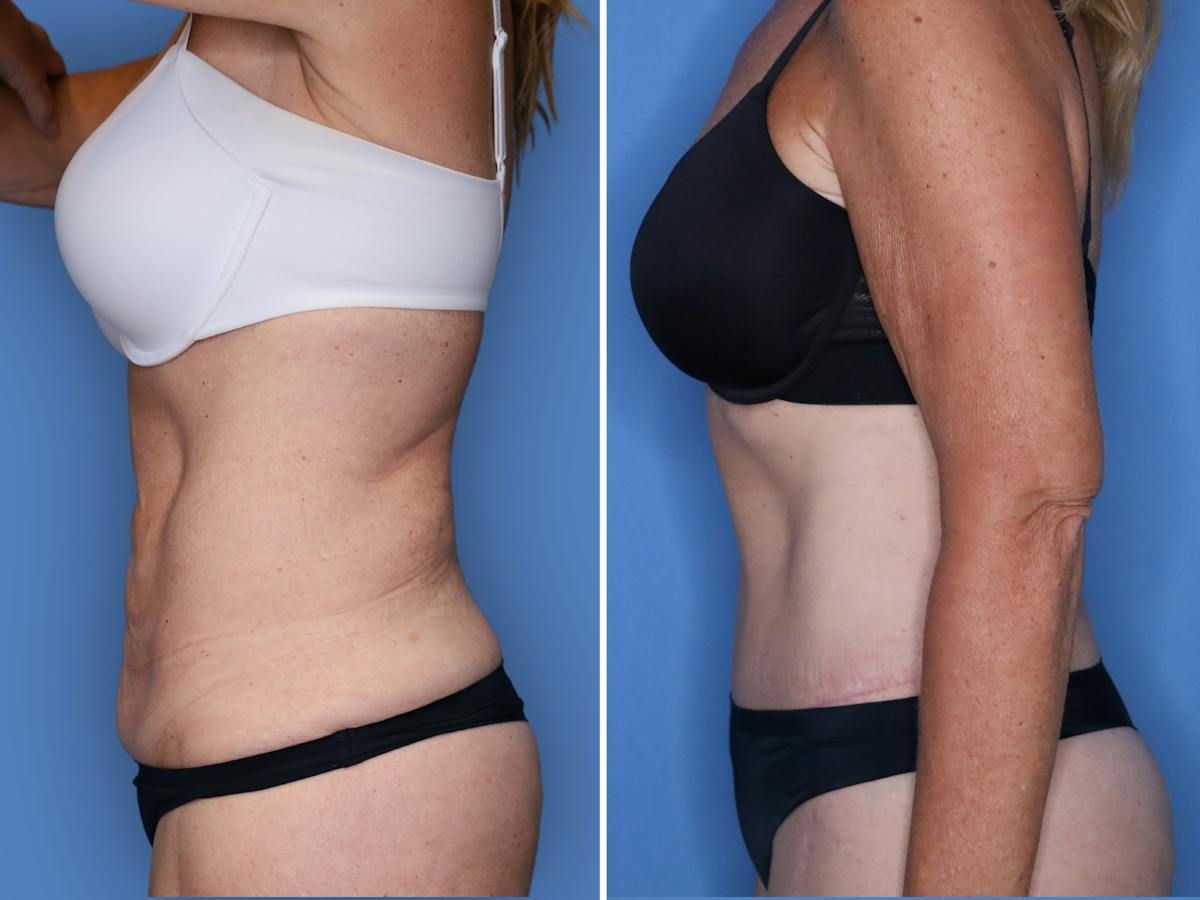 Abdominoplasty Before & After Gallery - Patient 285960 - Image 5