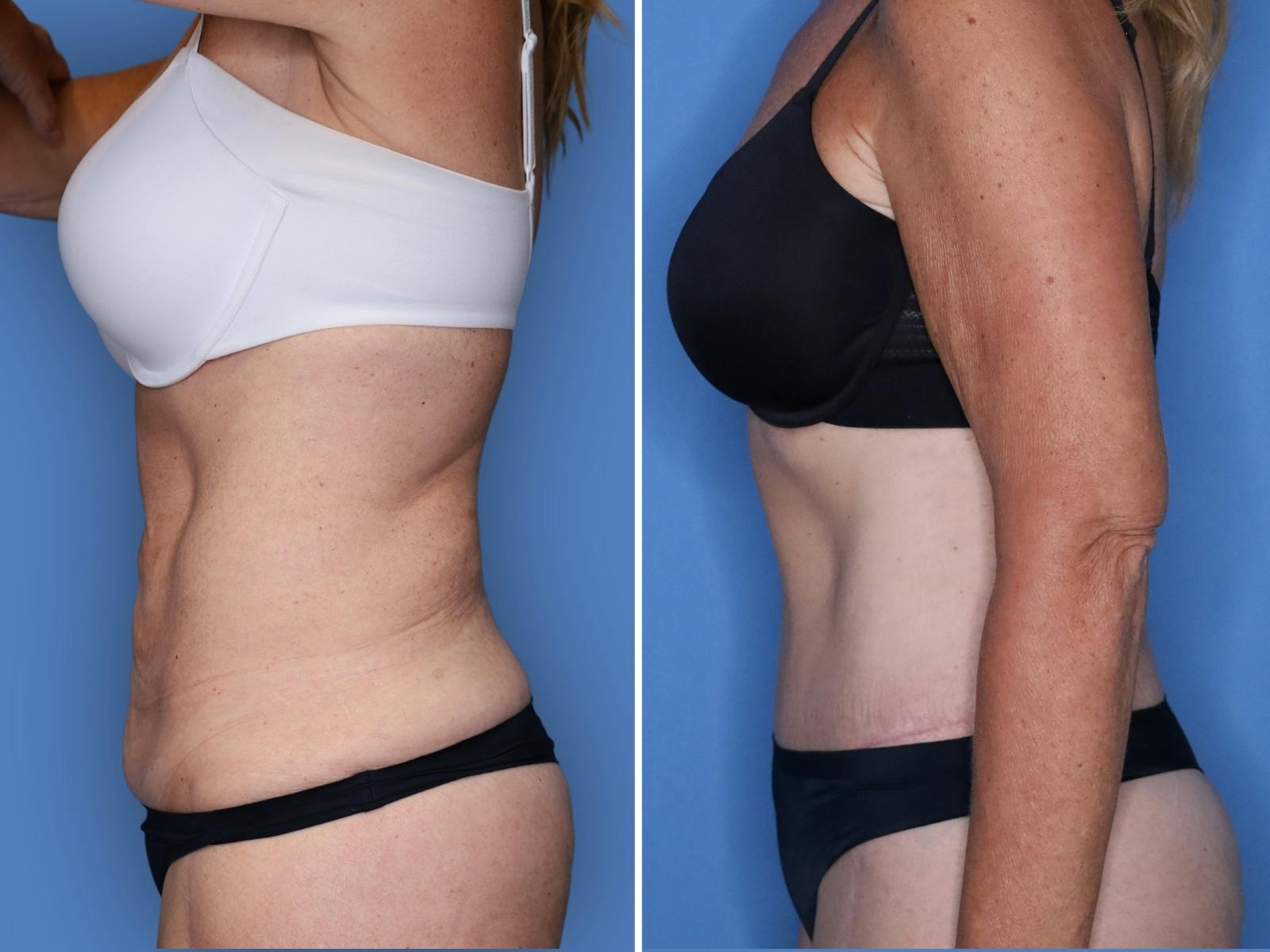 Abdominoplasty Before & After Gallery - Patient 285960 - Image 5