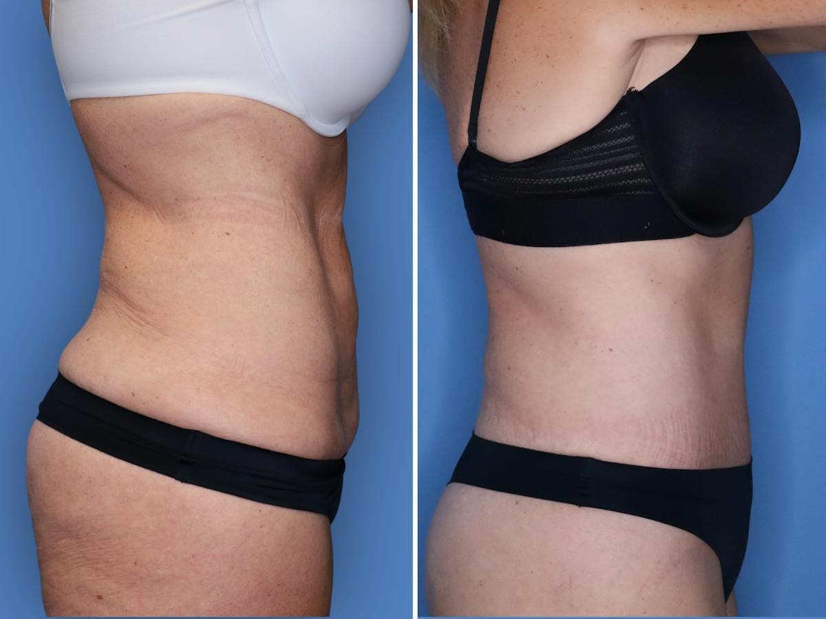 Abdominoplasty Before & After Gallery - Patient 285960 - Image 3