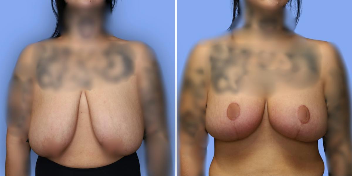 Breast Reduction Before & After Gallery - Patient 306147 - Image 1