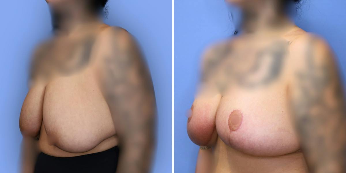 Breast Reduction Before & After Gallery - Patient 306147 - Image 4