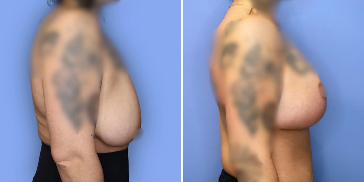 Breast Reduction Before & After Gallery - Patient 306147 - Image 3