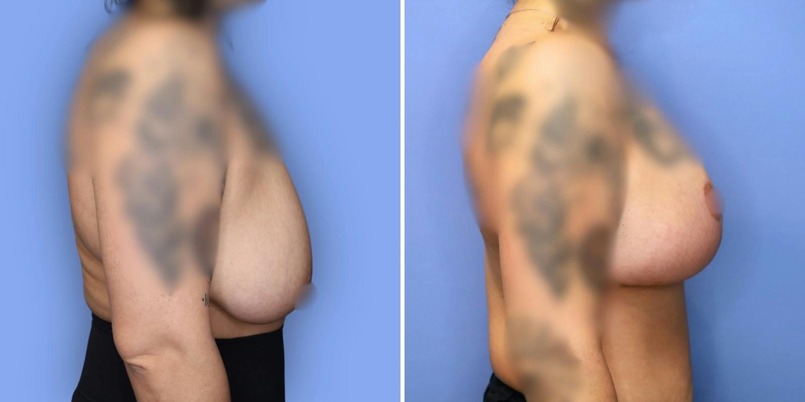 Breast Reduction Before & After Gallery - Patient 306147 - Image 3