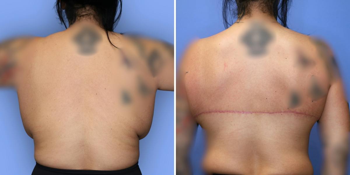 Breast Reduction Before & After Gallery - Patient 306147 - Image 6
