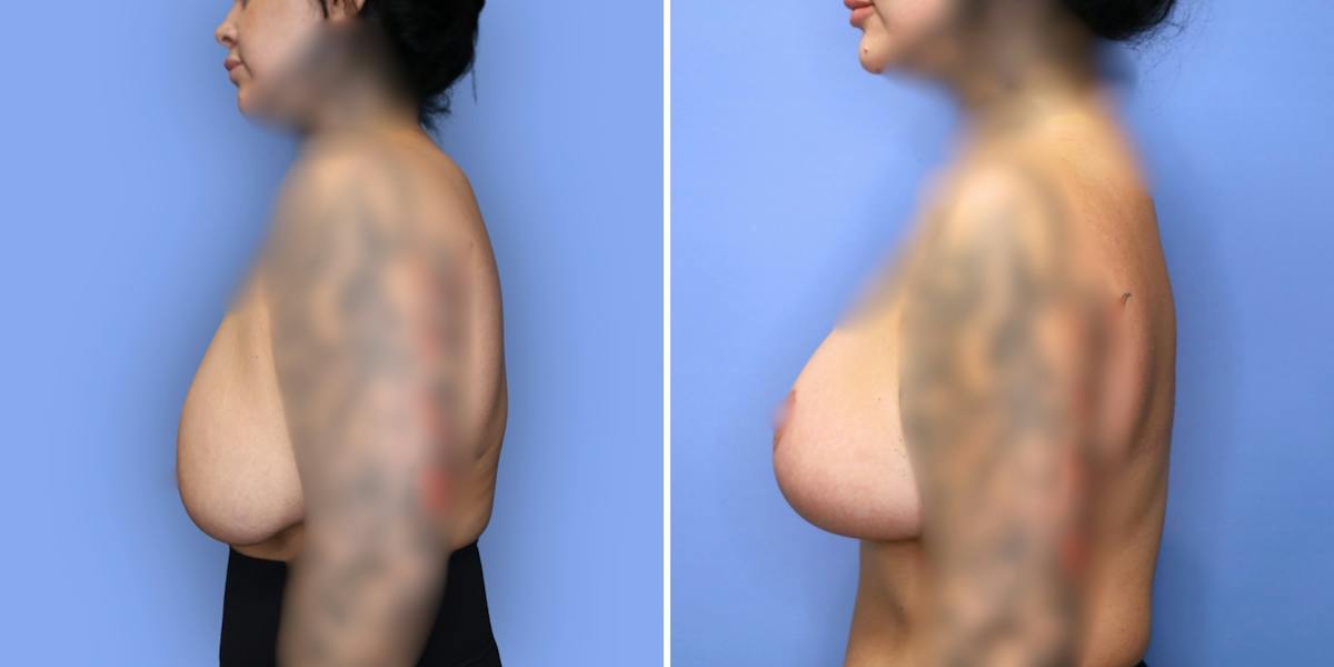 Breast Reduction Before & After Gallery - Patient 306147 - Image 5