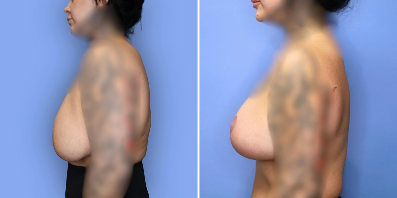 Breast Reduction Before & After Gallery - Patient 306147 - Image 5