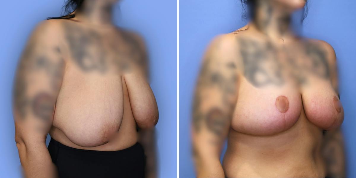 Breast Reduction Before & After Gallery - Patient 306147 - Image 2