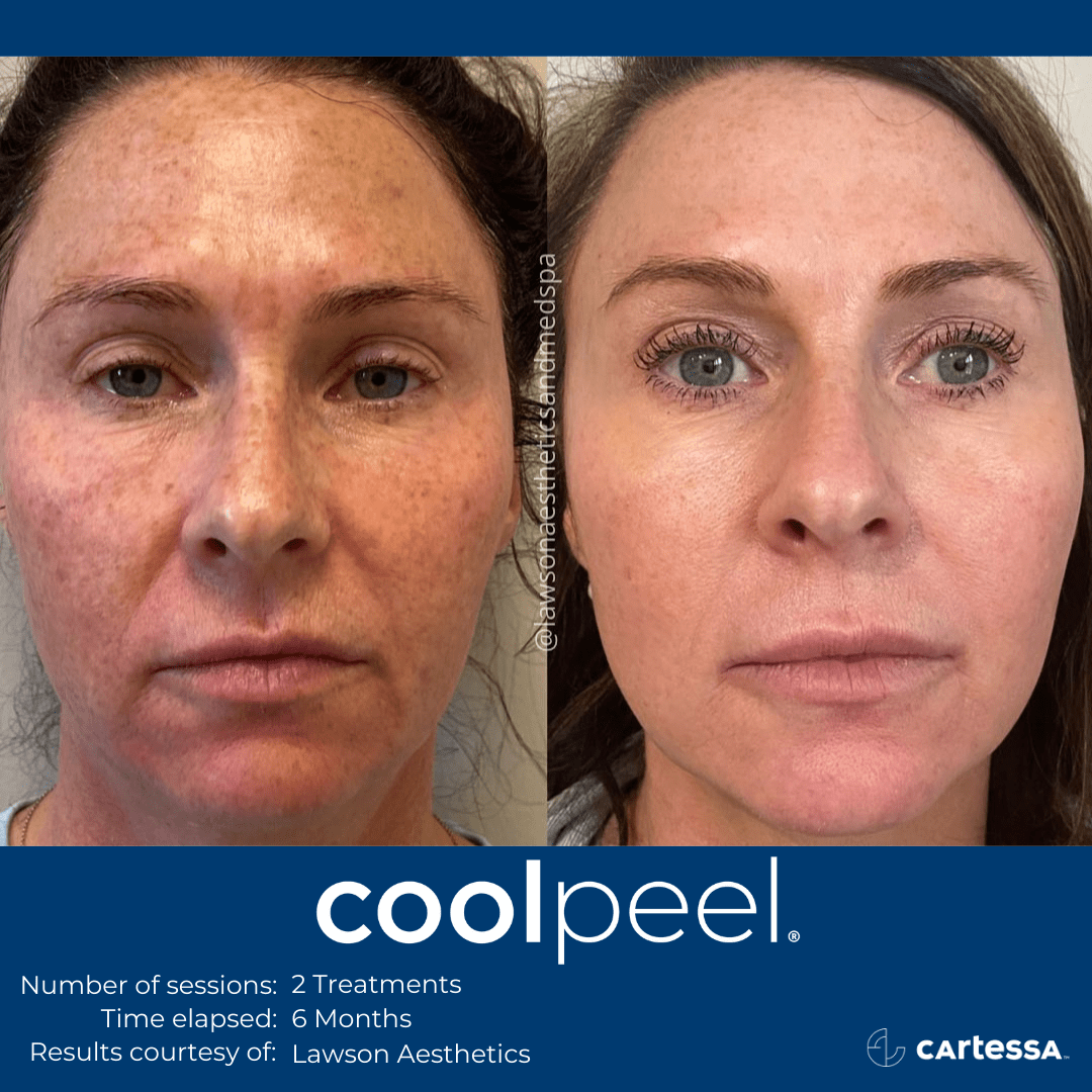 CoolPeel results