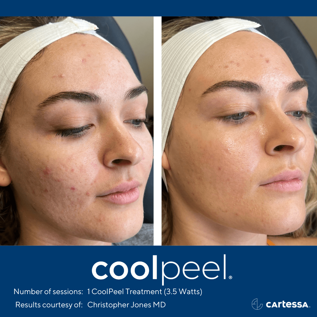 CoolPeel results