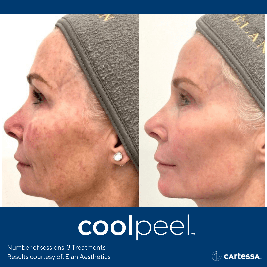 CoolPeel results