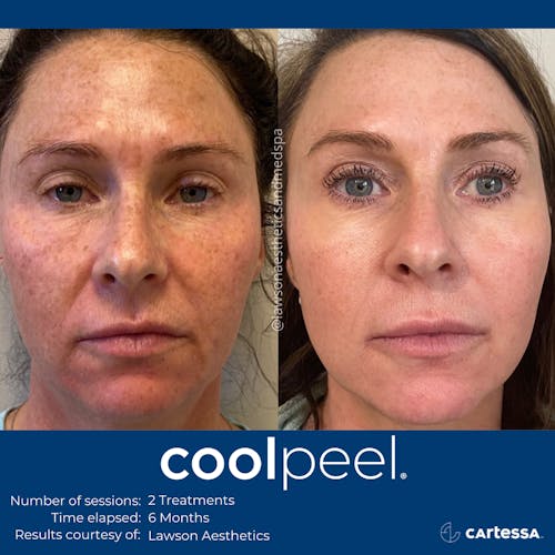 before/after