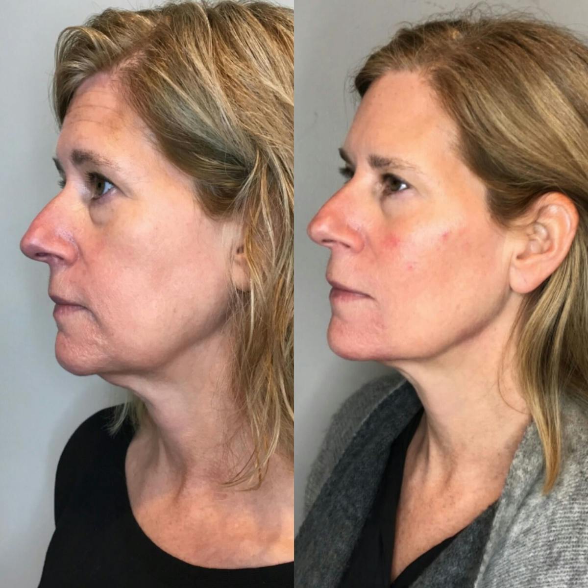 Dermal Fillers Before & After Gallery - Patient 374848 - Image 1