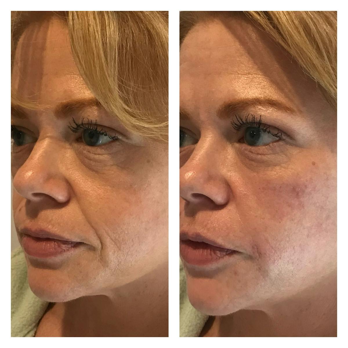 Dermal Fillers Before & After Gallery - Patient 850130 - Image 1