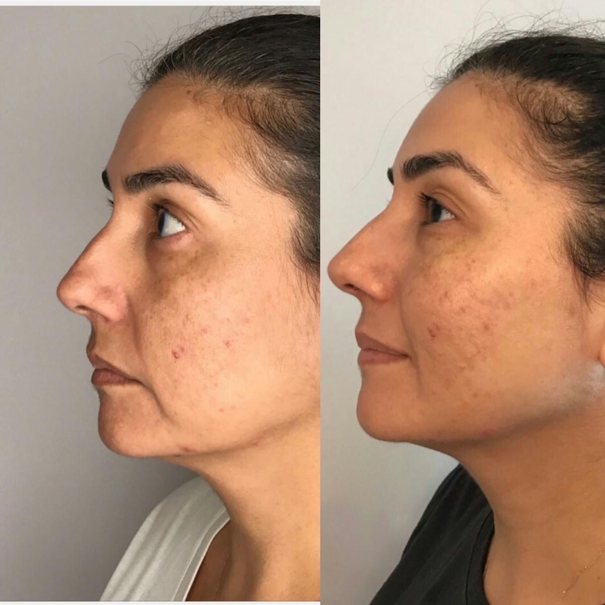 Dermal Fillers Before & After Gallery - Patient 112688 - Image 1