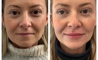 Dermal Fillers Before & After Gallery - Patient 197218 - Image 1