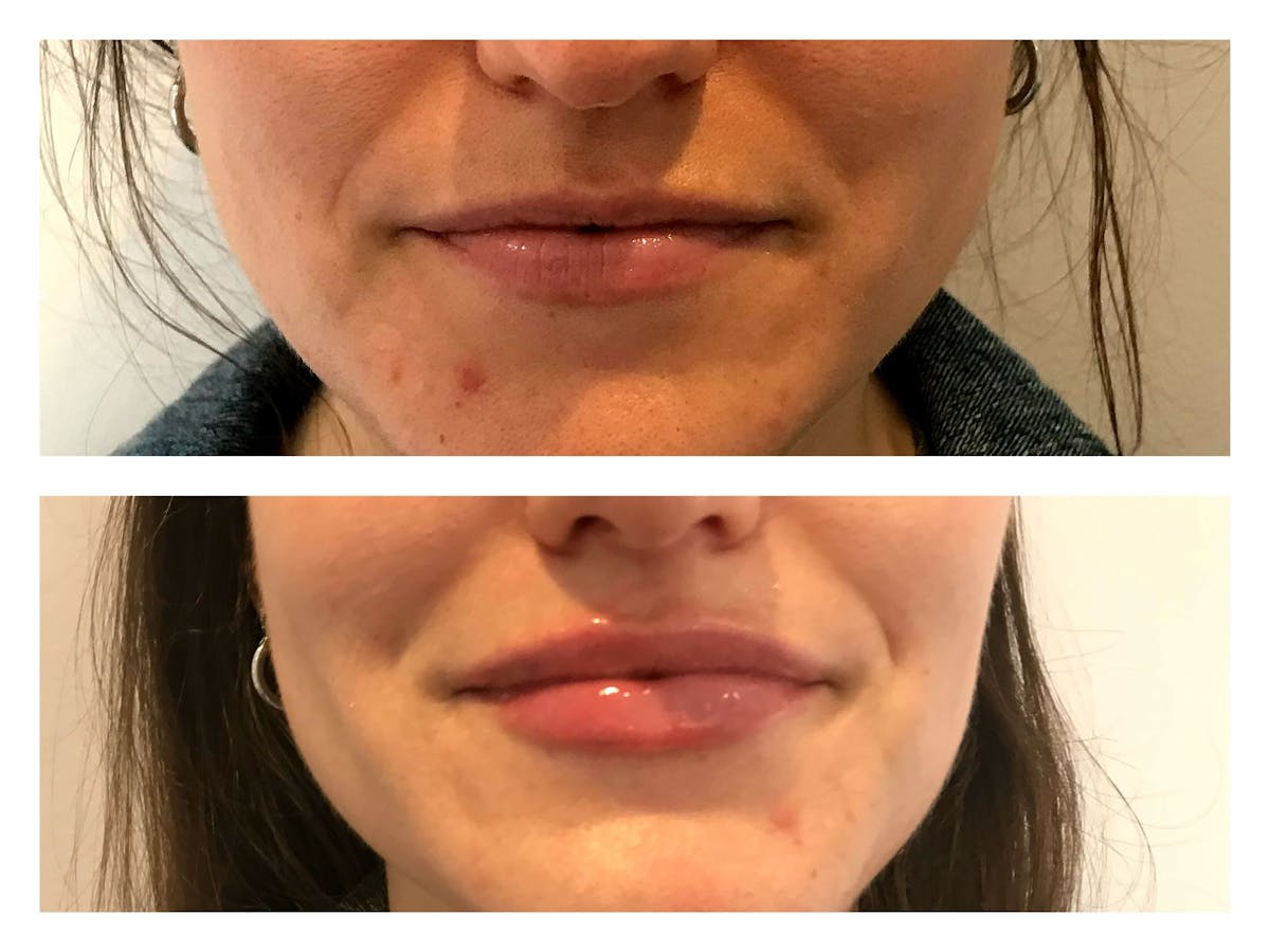 Dermal Fillers Before & After Gallery - Patient 137515 - Image 1