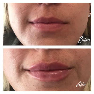 Dermal Fillers Before & After Gallery - Patient 120376 - Image 1