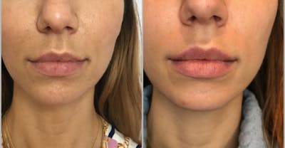 Dermal Fillers Before & After Gallery - Patient 281966 - Image 1