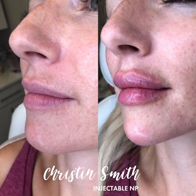 Dermal Fillers Before & After Gallery - Patient 638917 - Image 1