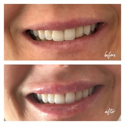 Dermal Fillers Before & After Gallery - Patient 194900 - Image 1