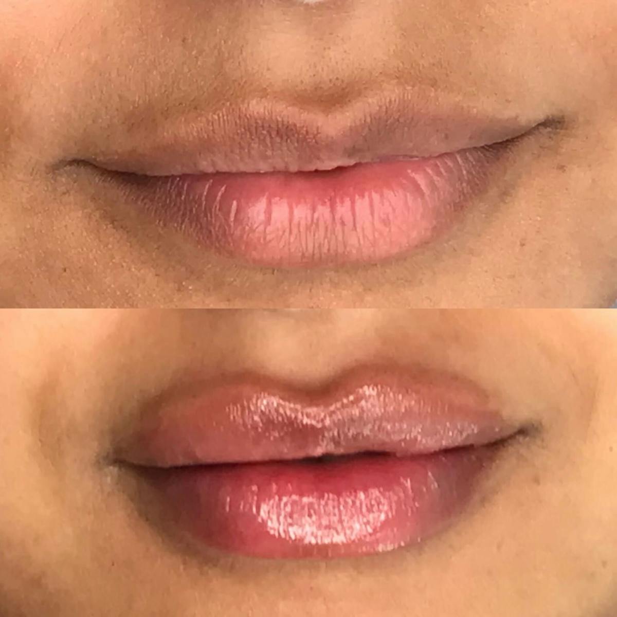 Dermal Fillers Before & After Gallery - Patient 143871 - Image 1