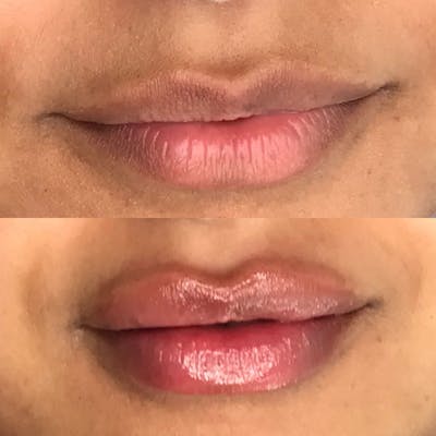 Dermal Fillers Before & After Gallery - Patient 143871 - Image 1