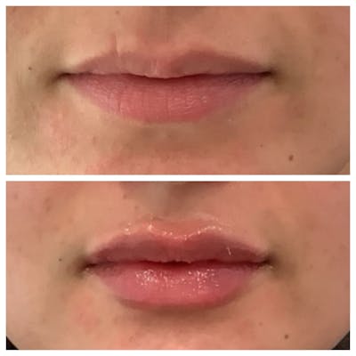 Dermal Fillers Before & After Gallery - Patient 130926 - Image 1