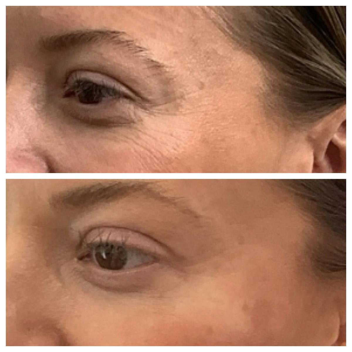 Wrinkle Relaxers Before & After Gallery - Patient 171714 - Image 1