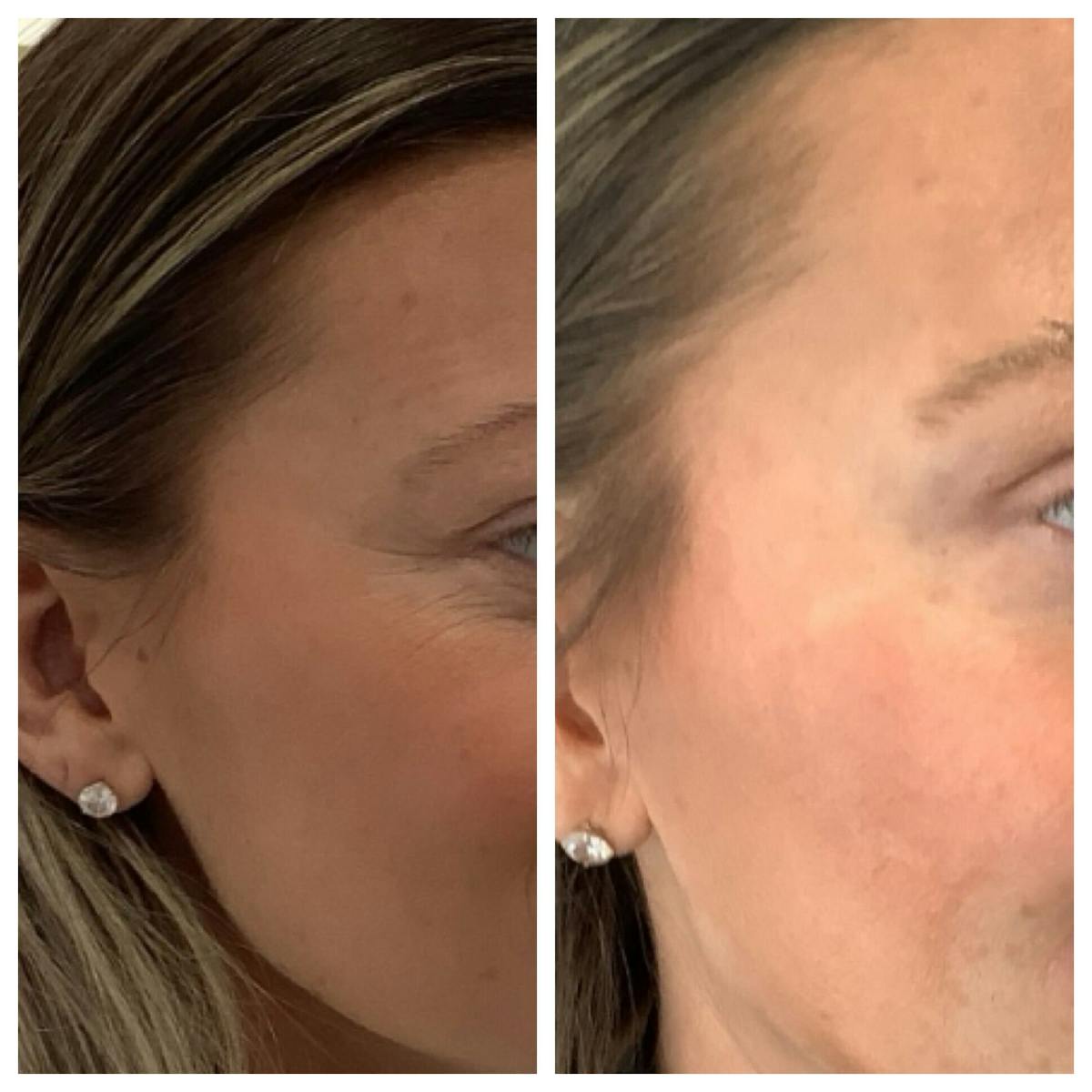 Wrinkle Relaxers Before & After Gallery - Patient 323776 - Image 1