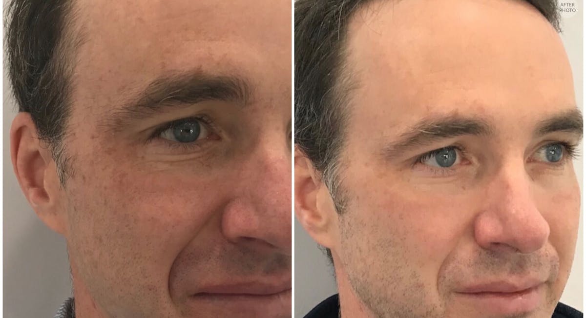 DEKA CO2 Laser Before & After Gallery - Patient 153705 - Image 1