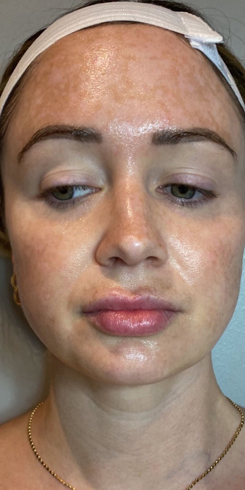 Vivace RF Microneedling Before & After Gallery - Patient 252135 - Image 1