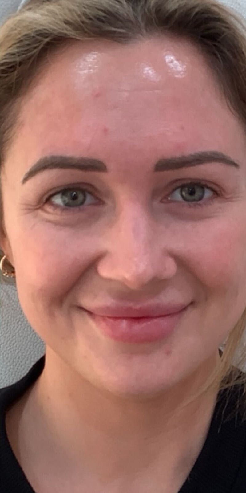 Vivace RF Microneedling Before & After Gallery - Patient 252135 - Image 2