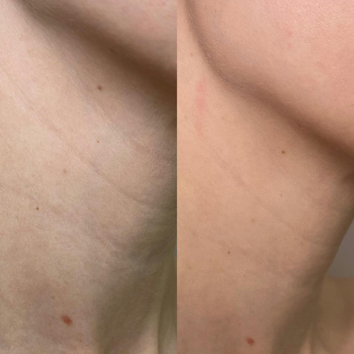 Cool Peel Before & After Gallery - Patient 184191 - Image 7
