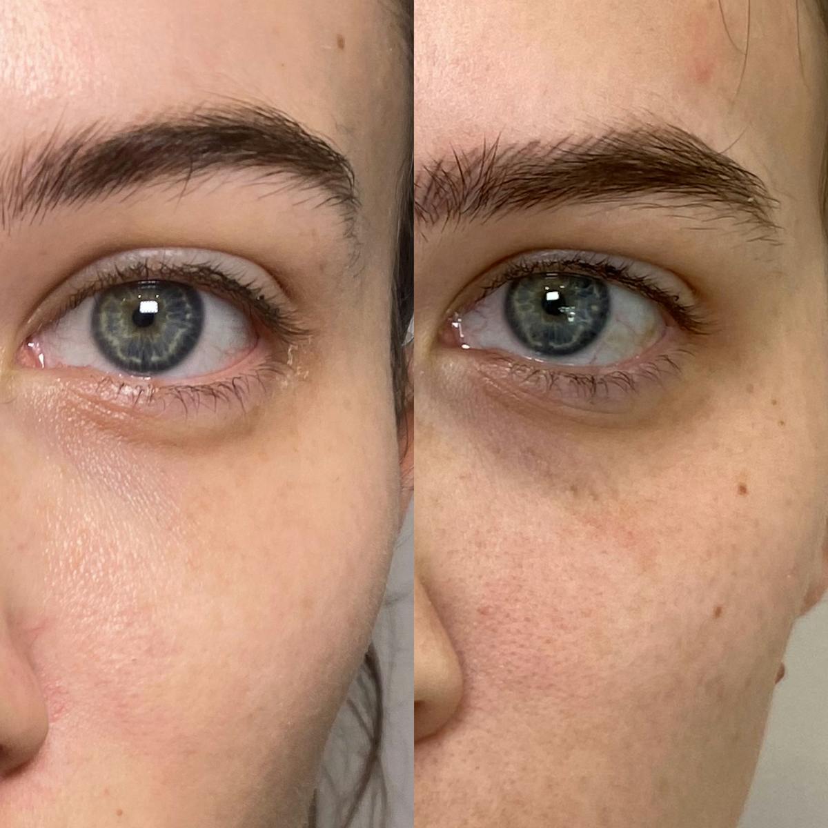 Cool Peel Before & After Gallery - Patient 184191 - Image 4