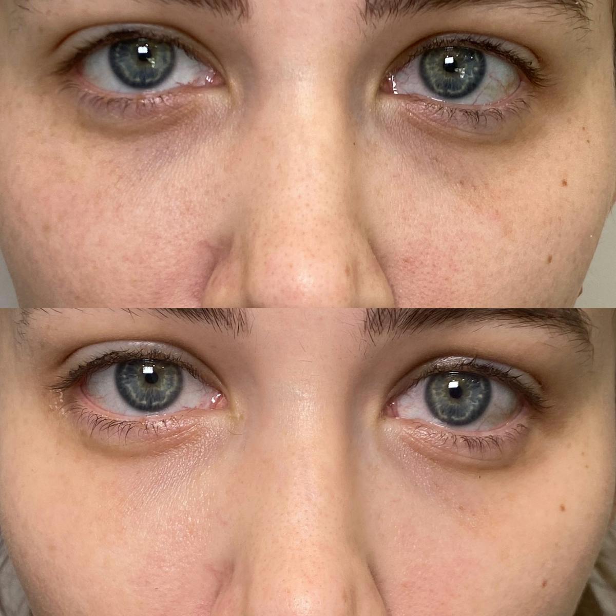 Cool Peel Before & After Gallery - Patient 184191 - Image 5