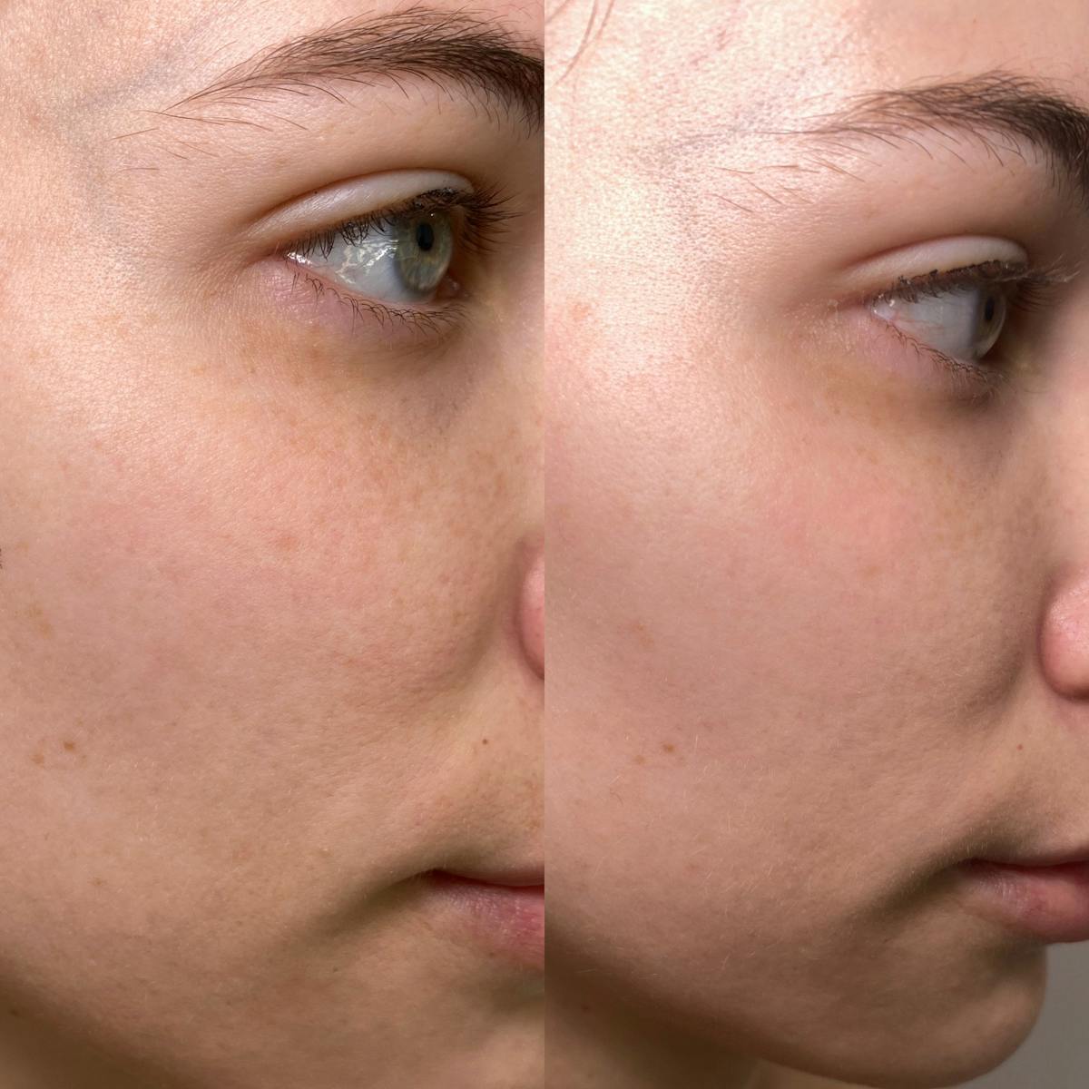 Cool Peel Before & After Gallery - Patient 184191 - Image 3