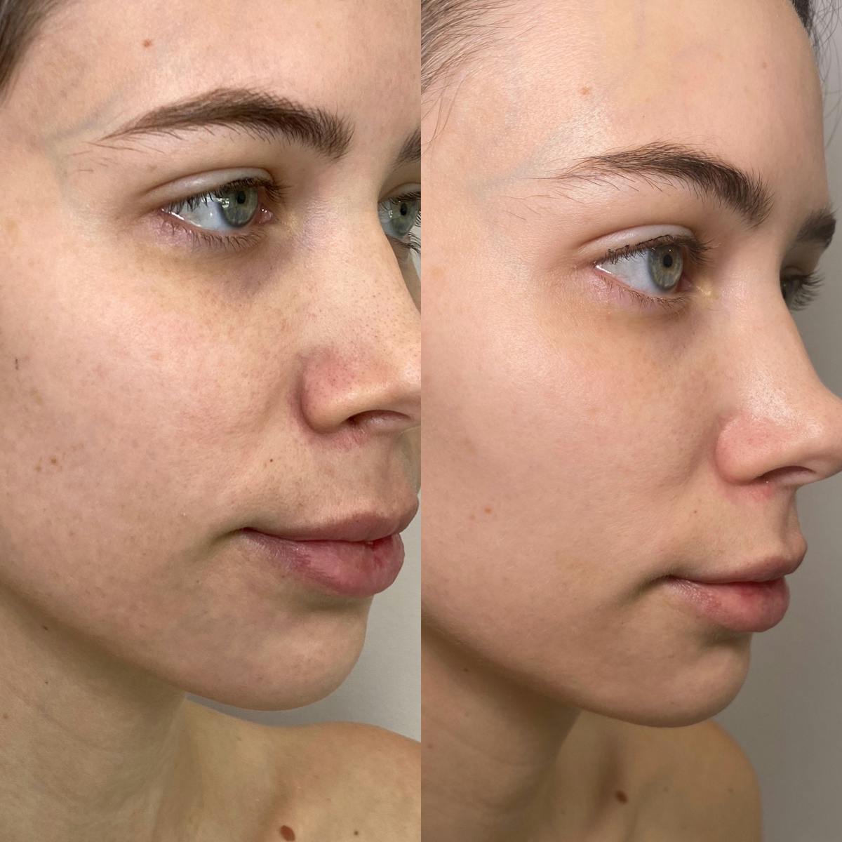 Cool Peel Before & After Gallery - Patient 184191 - Image 2