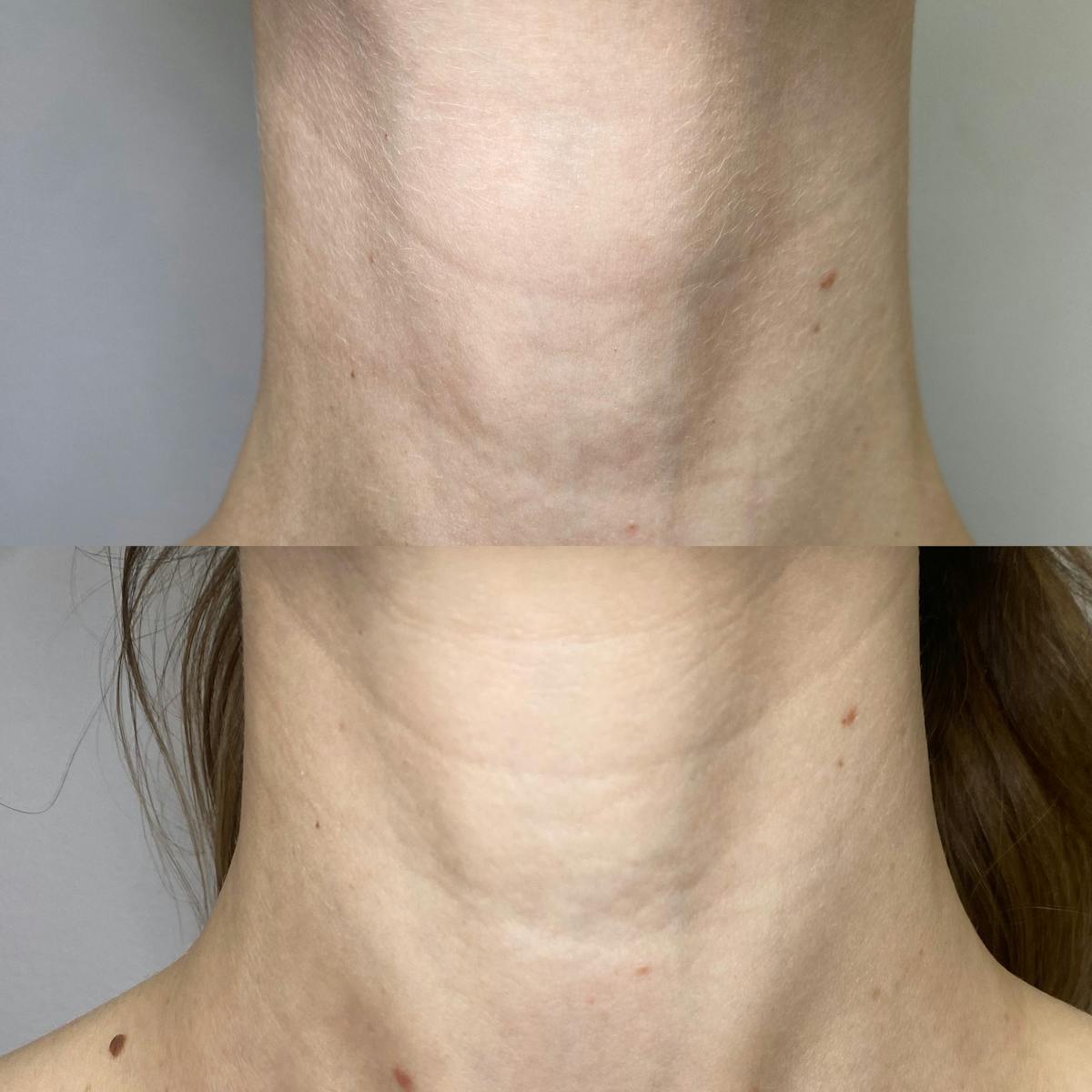 Cool Peel Before & After Gallery - Patient 184191 - Image 6