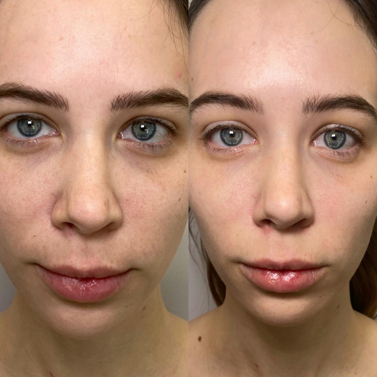 Cool Peel Before & After Gallery - Patient 184191 - Image 1