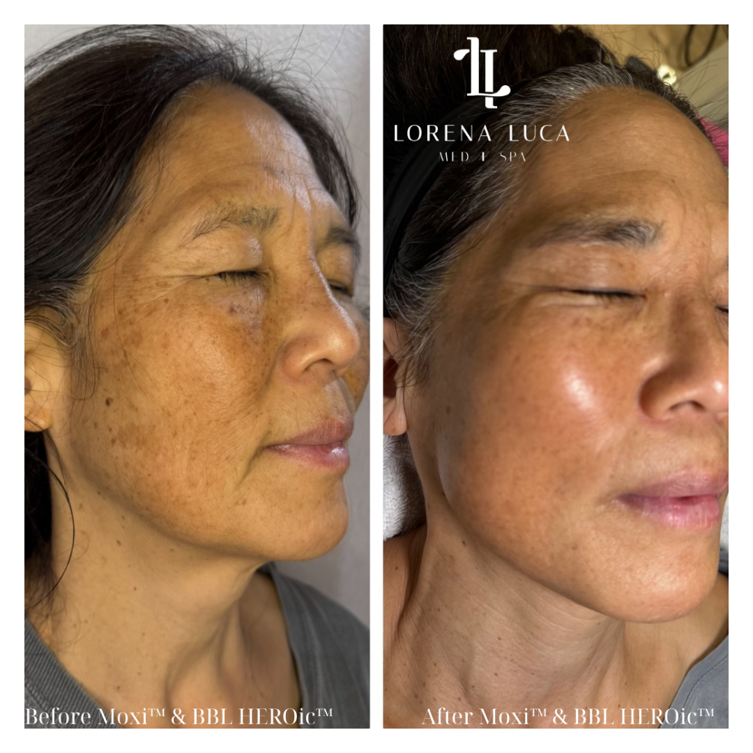 BBL before and after face