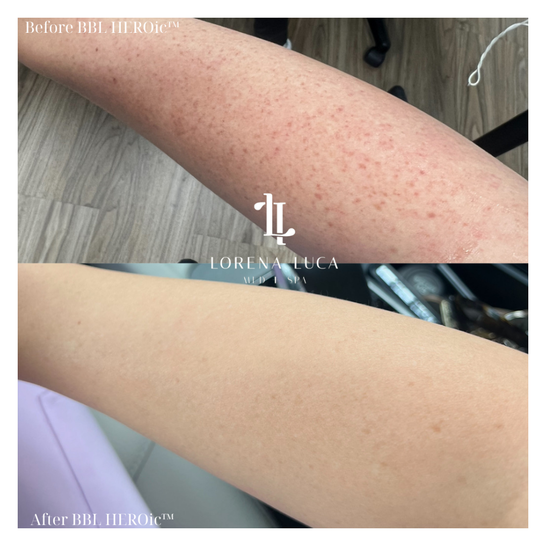 BBL before and after on arm